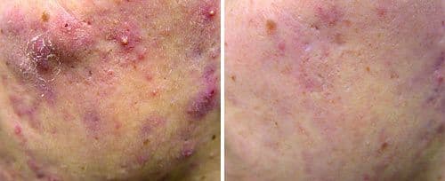 active_acne2_sult_rn.jpg
