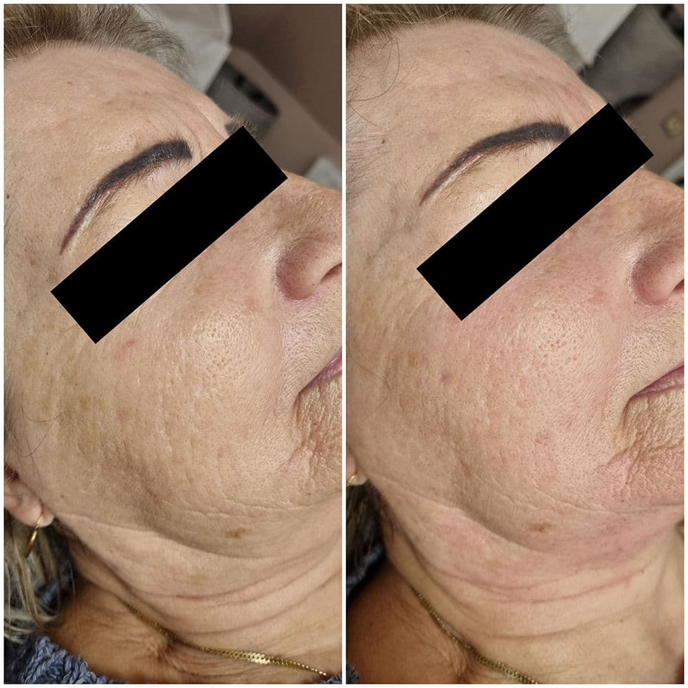 ef_5d_rejuvenacio_1-1.jpg