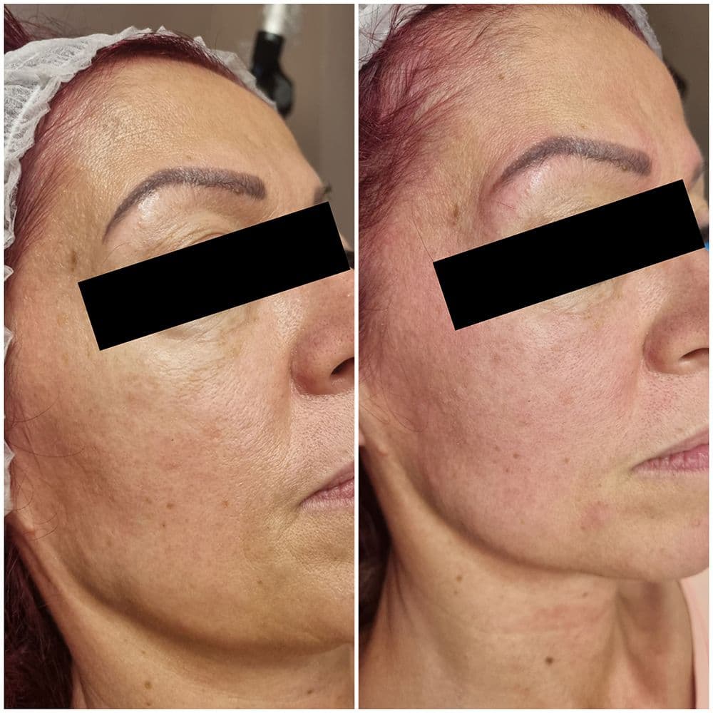 ef_5d_rejuvenacio_2.jpg