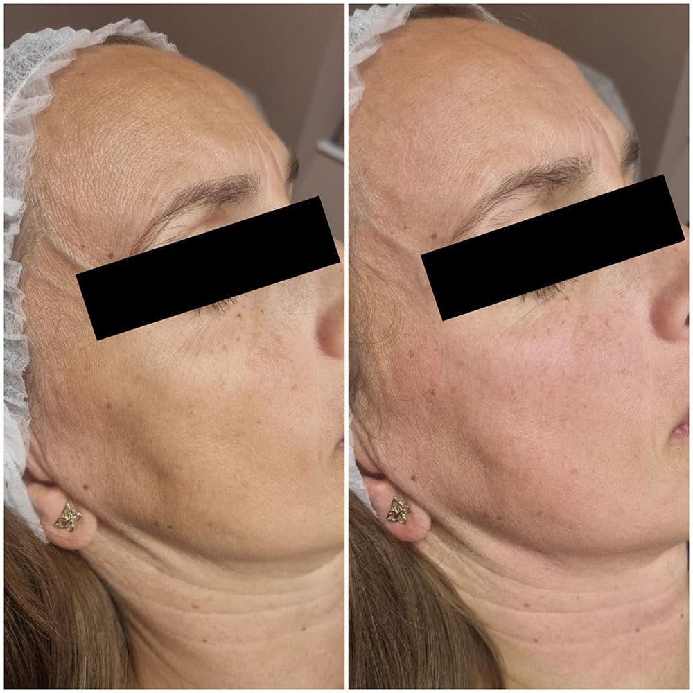 ef_5d_rejuvenacio_3.jpg